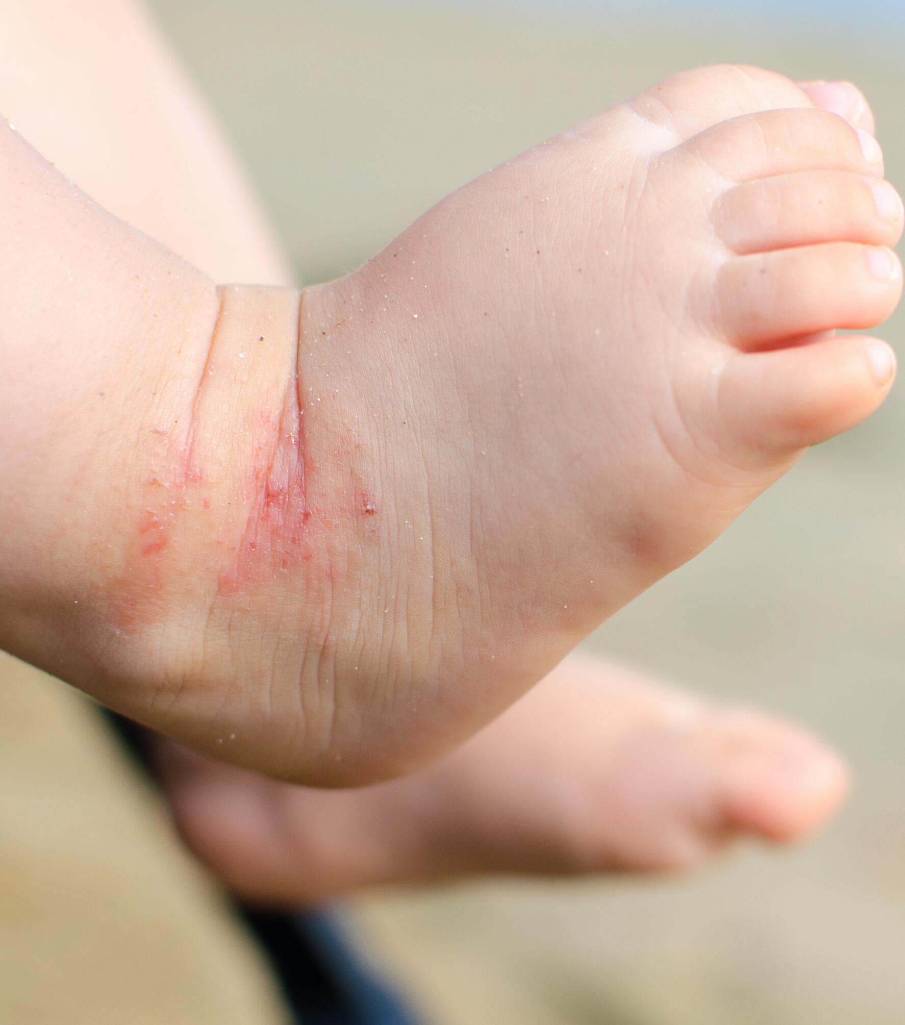 intertrigine piede neonato